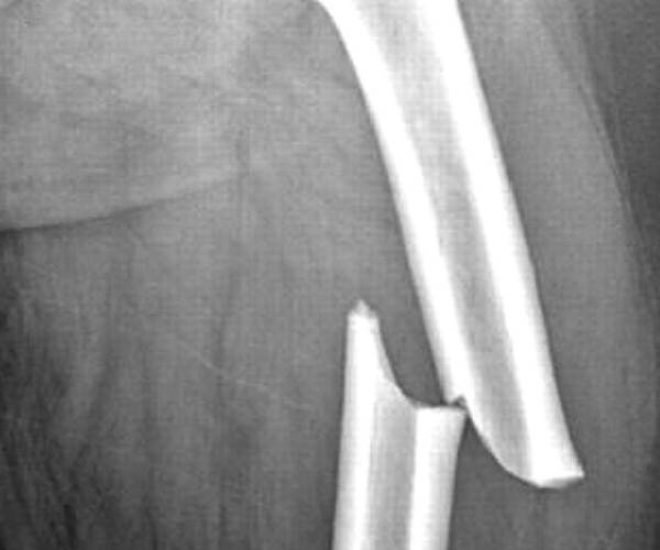 Fracture