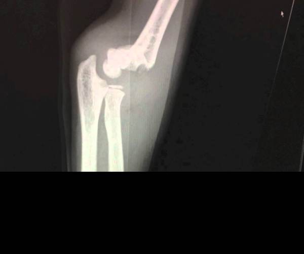 Fracture