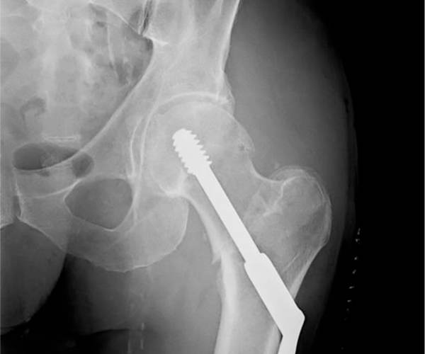 Fracture