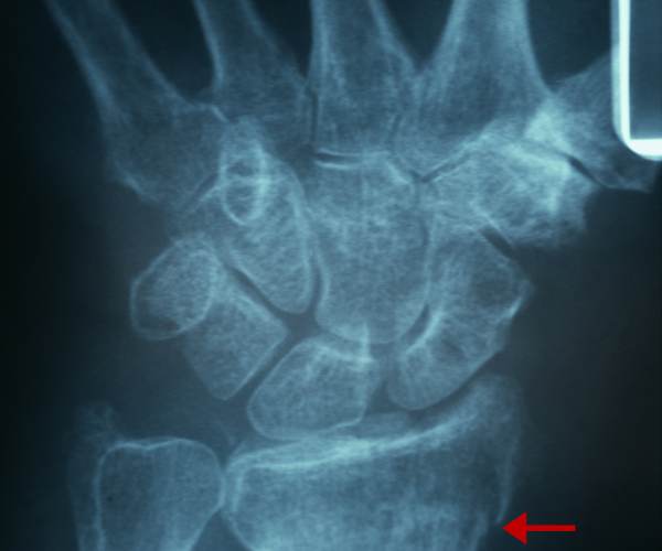 Fracture