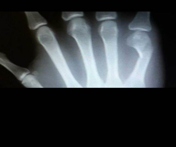 Fracture