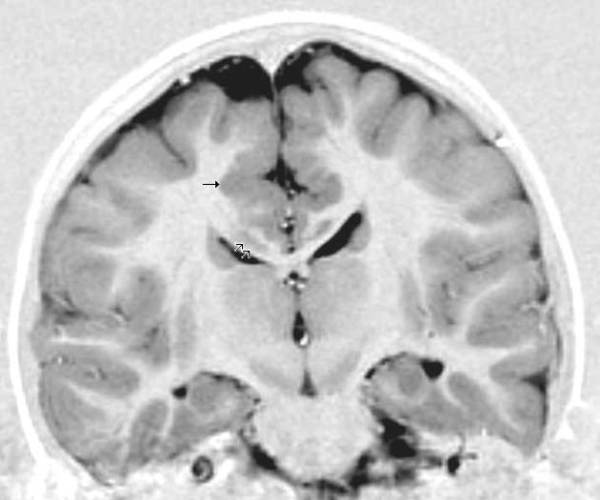 Gray Matter